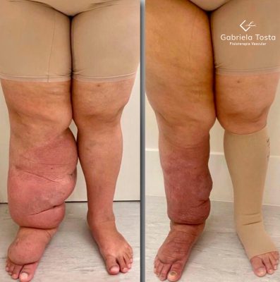 antes e depois linfedema
